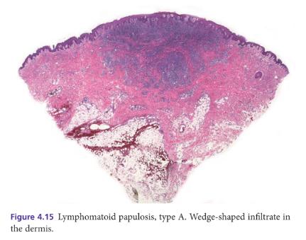 儿童淋巴瘤样丘疹病,到底需不需要激进治疗?