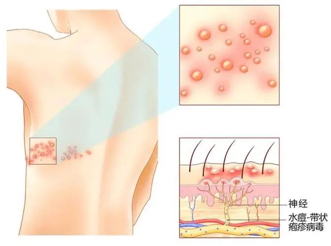 带状疱疹位置图片