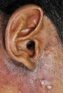 莫惊慌,儿童皮肌炎与肿瘤无关!_澎湃号·政务_澎湃新闻-the paper