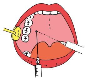 拔牙打麻药会损伤大脑吗?