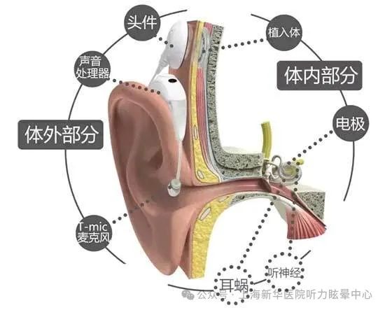 在这个过程中,听力师通过电脑和相关调机设备,对人工耳蜗的参数进行