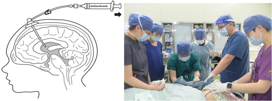 图2 侧脑室注射基因治疗上海交通大学医学院附属新华医院张惠文教授