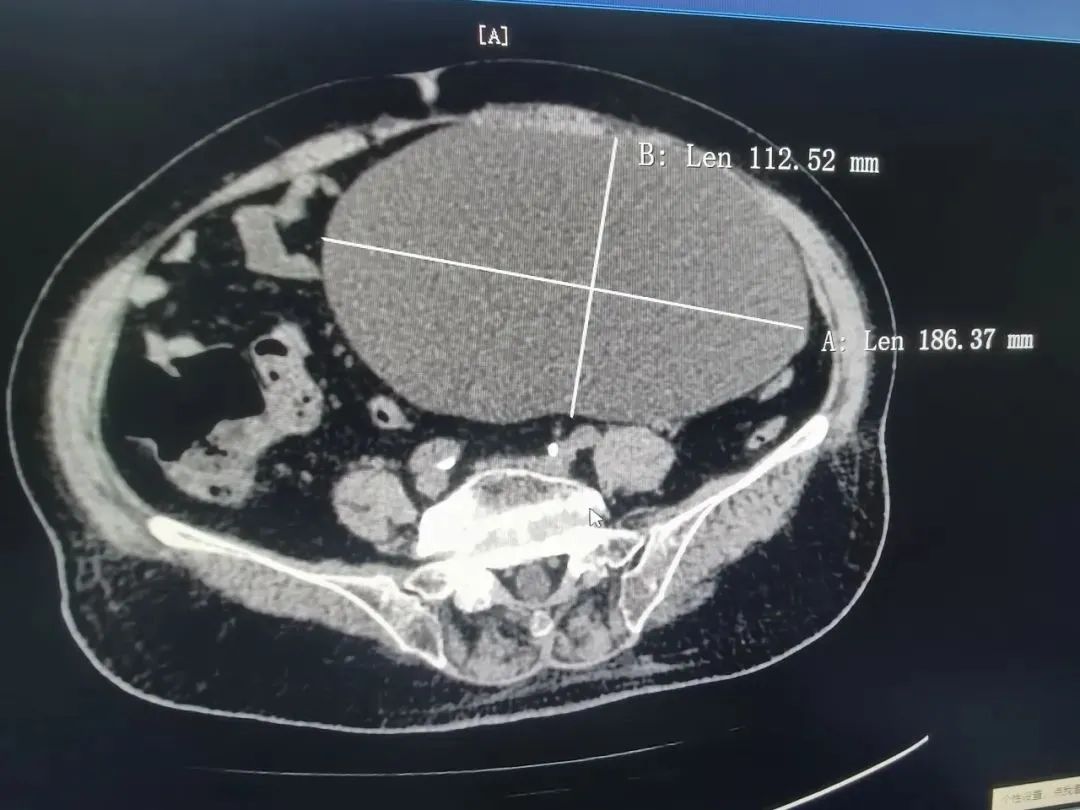 18厘米巨大肿瘤占满83岁阿婆盆腔,多学科团队紧密协作联合"拆弹"