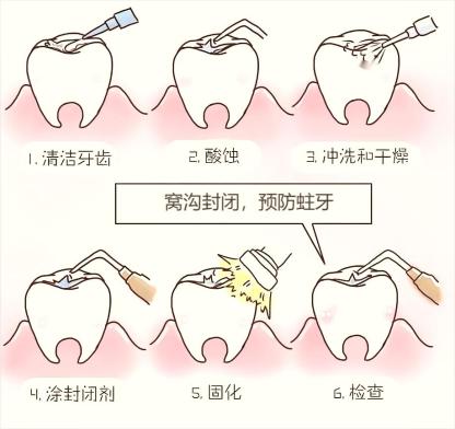 窝沟龋齿怎么治疗图片