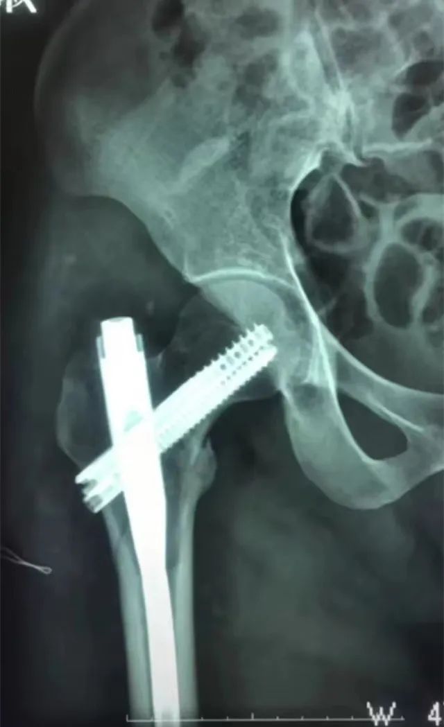 开展年轻股骨粗隆间骨折患者的intertan髓内钉技术,对照pfna技术而言