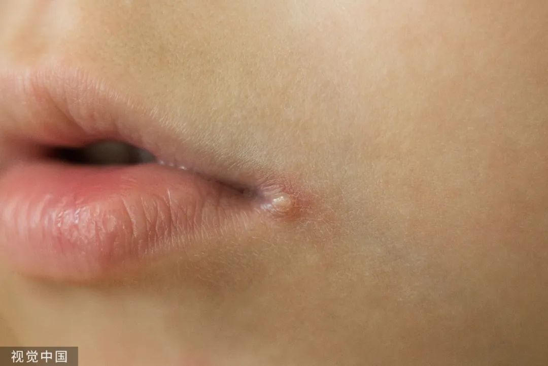 1.鼻出血,尿路感染,真菌感染,都不建议用红霉素药膏.2.