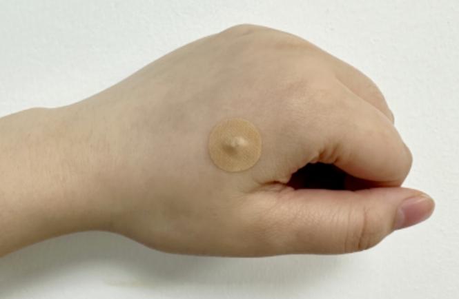 可吸收羊肠线埋入人体相应穴位,使其产生持续刺激作用而替代针灸留针