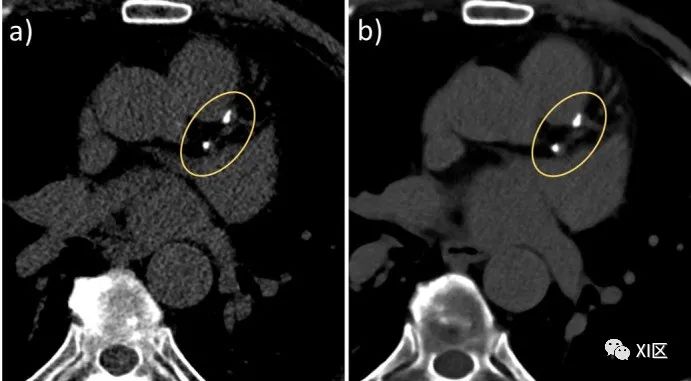 光子计数ct心脏成像研究进展_澎湃号·湃客_澎湃新闻-the paper