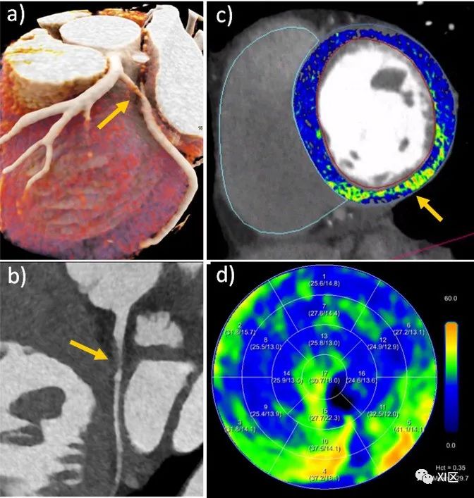 光子计数ct心脏成像研究进展_澎湃号·湃客_澎湃新闻-the paper