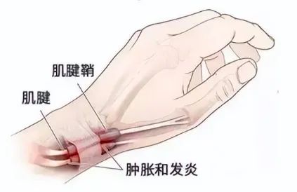 尺侧腕屈肌腱鞘炎图片