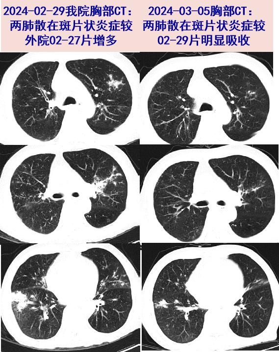 探案丨肾移植患者的肺炎,你想到这个元凶了吗?