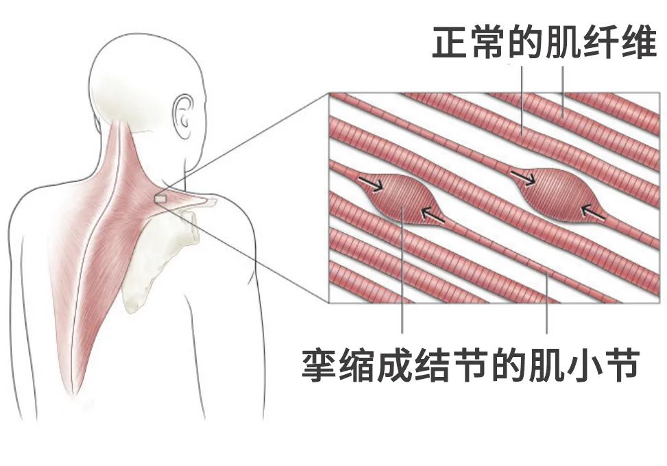 收肌结节图片