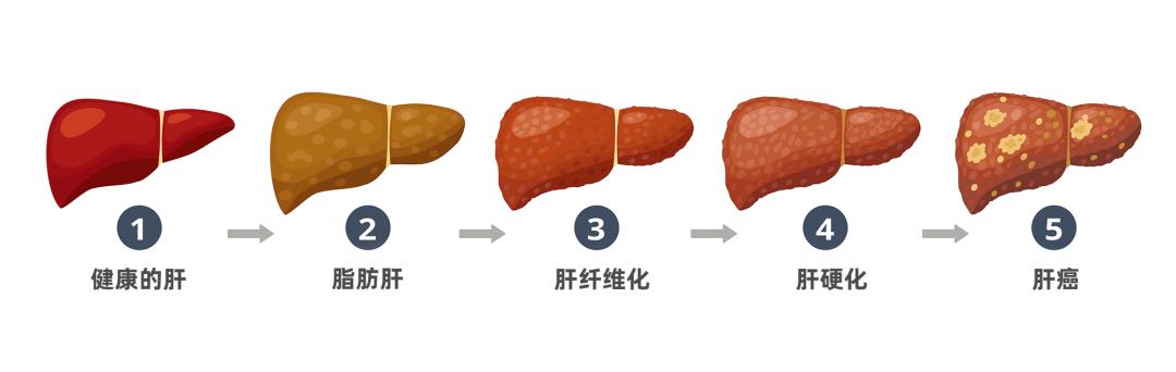 从脂肪肝到肝癌只有4步,医生一招帮你逆转
