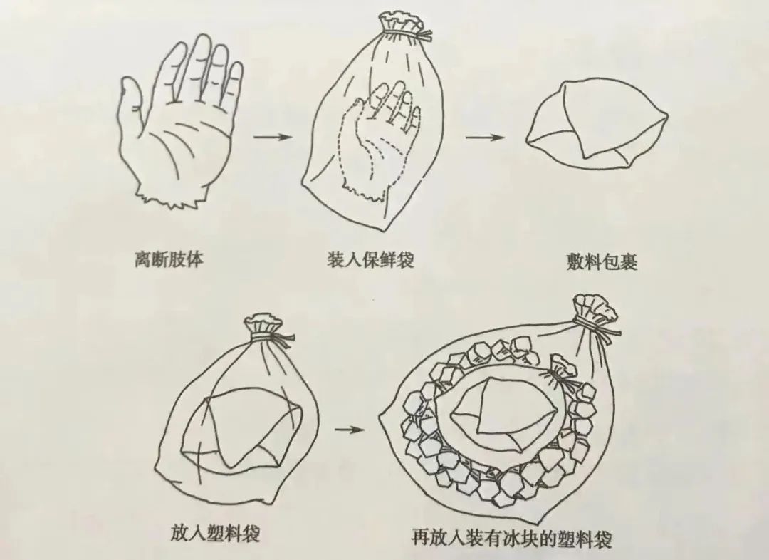小伙手掌整个绞断,军医8小时成功"接活"!