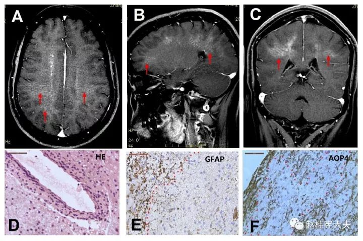 自身免疫胶质纤维酸性蛋白(gfap)星形细胞病_澎湃号·湃客_澎湃新闻