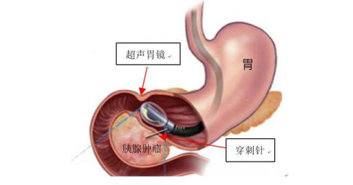 1986年,随着世界上第一台超声内镜的诞生完美将内镜和超声技术结合在