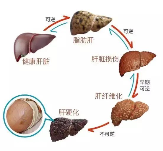 血吸虫性肝硬化图片