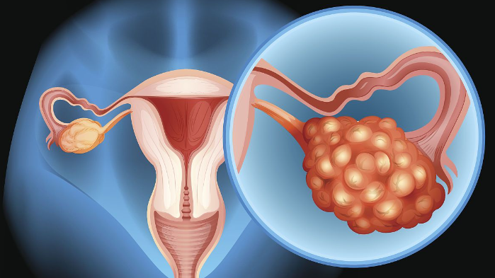 如何正确打开“多囊卵巢综合征”的生活方式？