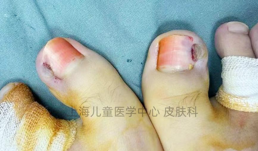 甲沟炎(嵌甲)除了换药,拔甲,还有什么妙招?