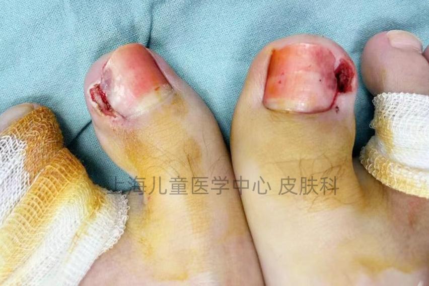 甲沟炎(嵌甲)除了换药,拔甲,还有什么妙招?