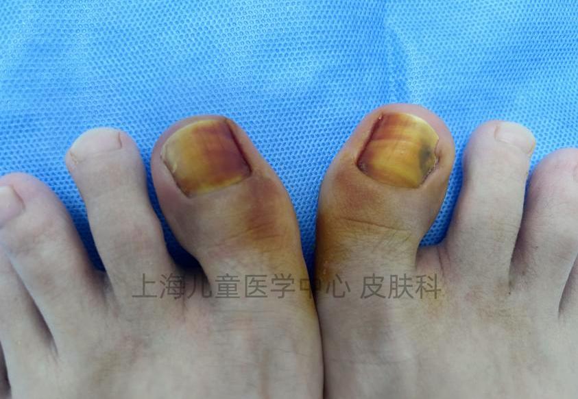 甲沟炎(嵌甲)除了换药,拔甲,还有什么妙招?