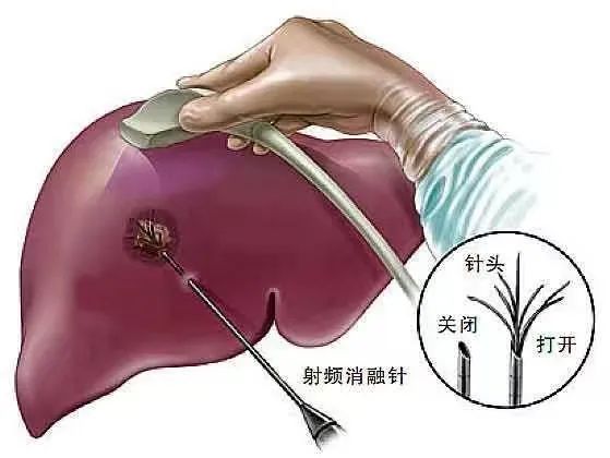 肝癌介入栓塞图片图片