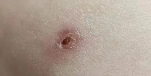 公共卫生论与谈健康科普宝宝接种卡介苗这些知识你知道吗