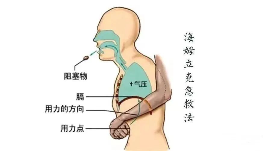 海姆立克急救法的原理食物卡喉如何自救避免意外发生掌握"海姆立克