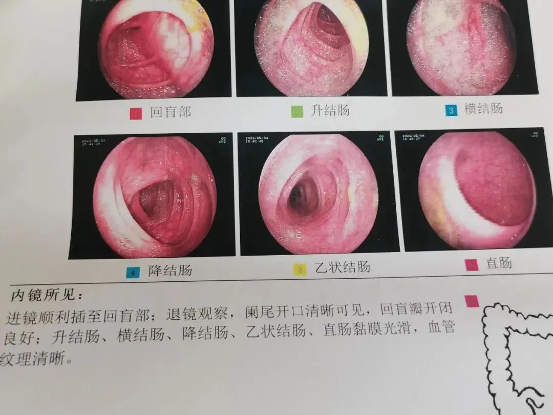 怕肠癌,又不想做肠镜?