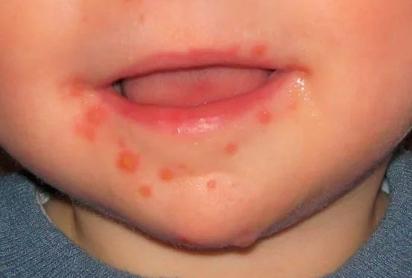 (口周疱疹)(手部皮疹)(足部疱疹)(臀部皮疹)柯萨奇病毒a组6型(cv-a6)