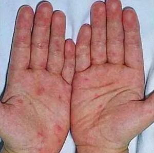 (手部皮疹)(足部疱疹)(臀部皮疹)柯萨奇病毒a组6型(cv-a6)引起的手足