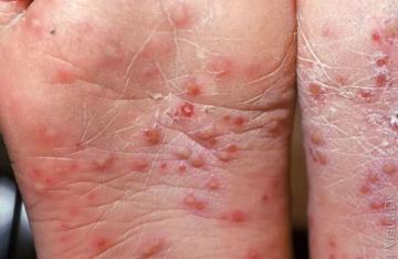 (足部疱疹)(臀部皮疹)柯萨奇病毒a组6型(cv-a6)引起的手足口病,在发病