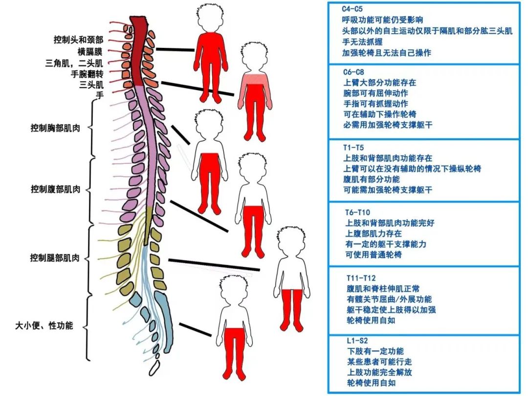 脊髓损伤感觉关键点图片