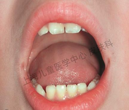 副乳,副耳屏,人类尾巴?这些都是发育异常胎记?