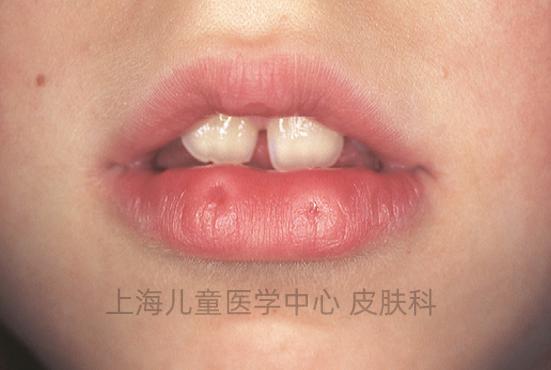 这些都是发育异常胎记?_澎湃号·湃客_澎湃新闻-the paper
