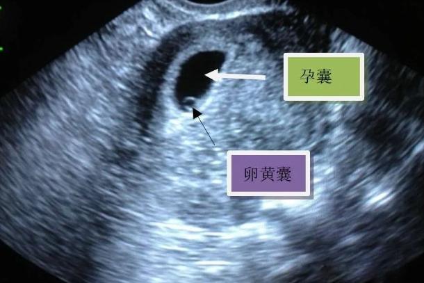受精卵的发育过程是子宫内依次显现出孕囊——胎芽——胎心,而显现的