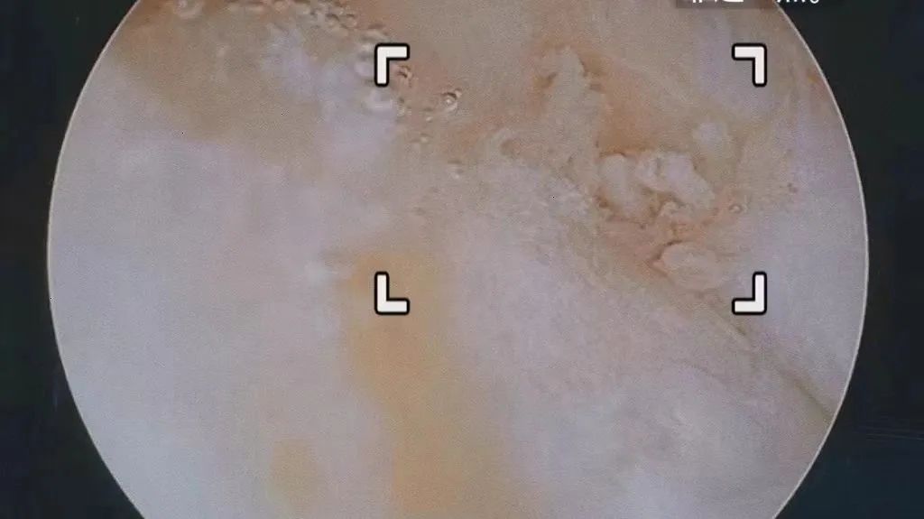 区方塔中医医院骨伤科成功开展首例膝关节镜手术_澎湃