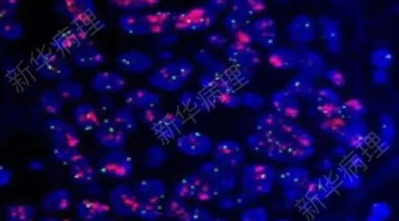 病理科的小"鱼"儿,"荧光原位杂交(fish)技术"_澎湃号·湃客_澎湃新闻