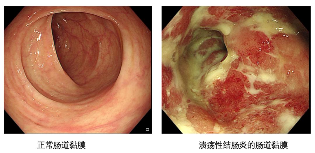严重直肠溃疡图片图片