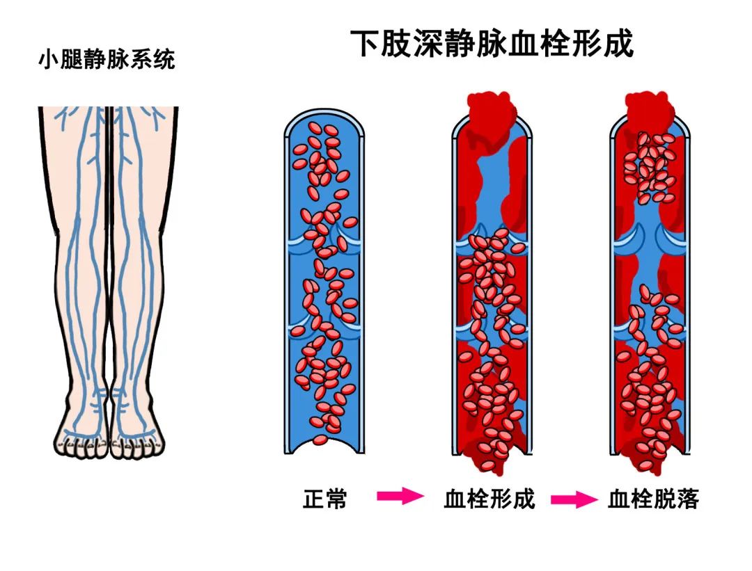脑卒中偏瘫患者下肢深静脉血栓的预防_澎湃号·政务_澎湃新闻-the