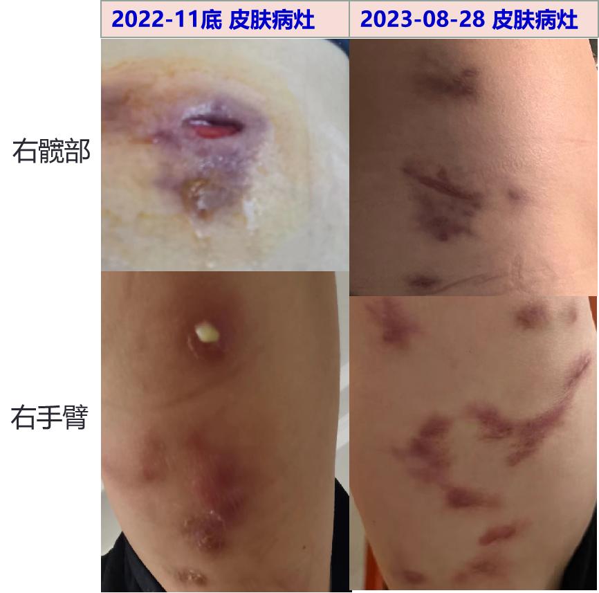 查体:双侧上臂,双侧腿部上方皮肤软组织见紫色疤痕,无明显渗出,红肿