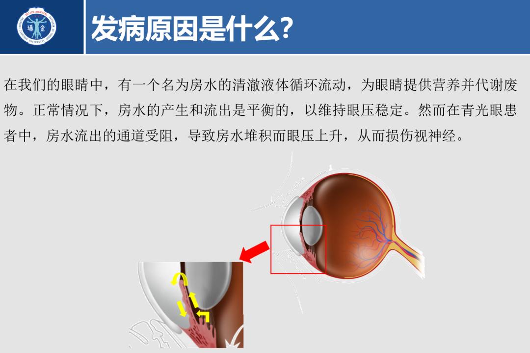 警惕视力杀手——青光眼的合理用药