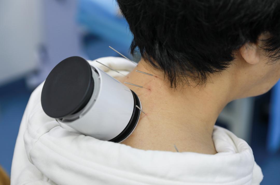 室,就闻到一股艾草独有的药草香,中医医师正在为患者进行艾灸,针灸,拔