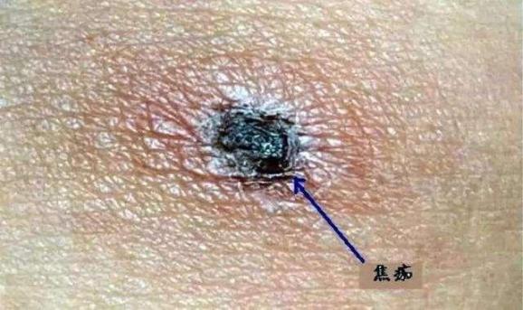 被恙虫叮咬后形成的焦痂专家提醒,恙虫爱潜伏在地势比较低洼,潮释和