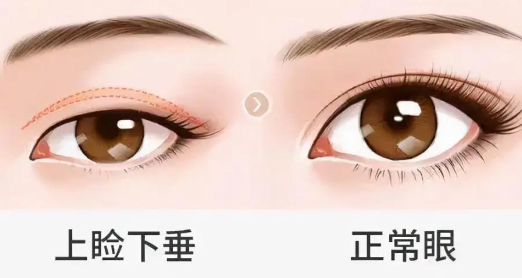 在检查中,邱威发现,小马属于先天性上睑下垂,提上睑肌肌力仅有5mm,睑