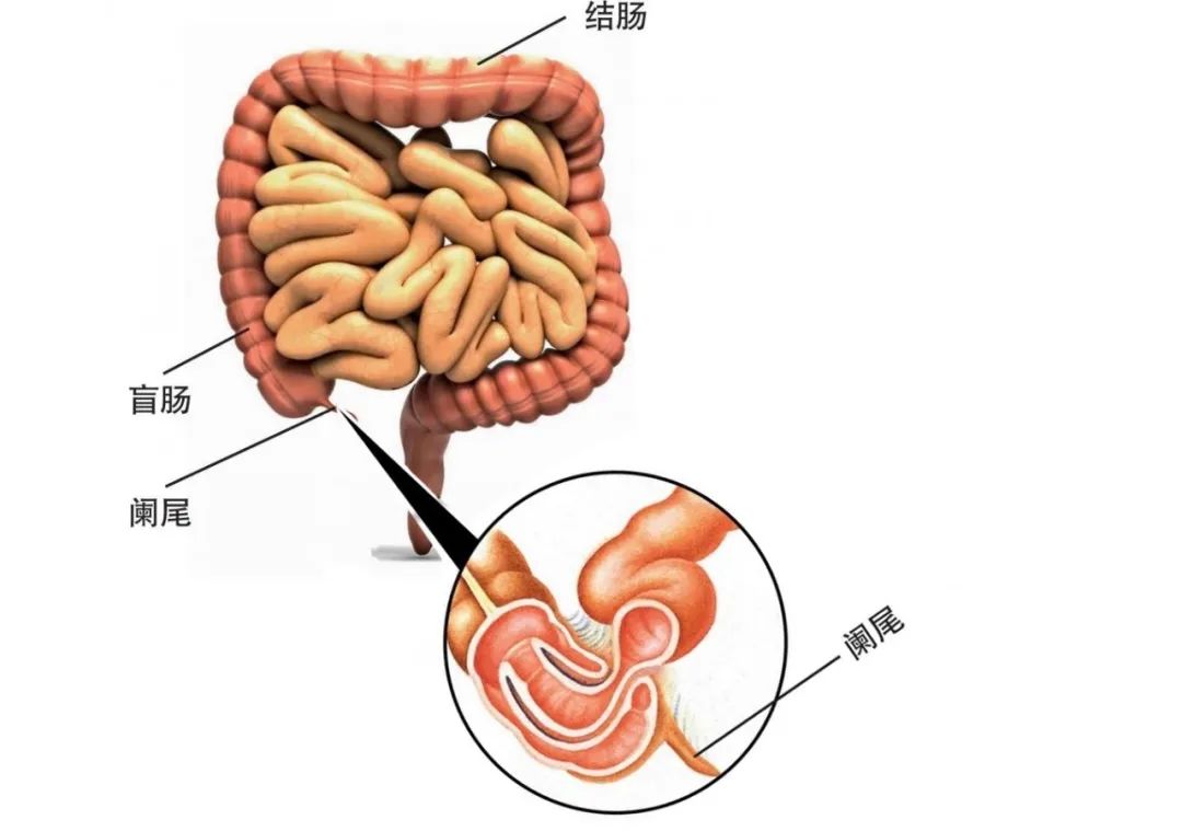 阑尾炎居然和饭后运动没关系?