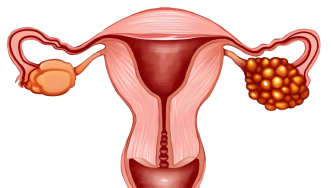 多囊卵巢综合征，该如何促排卵治疗？