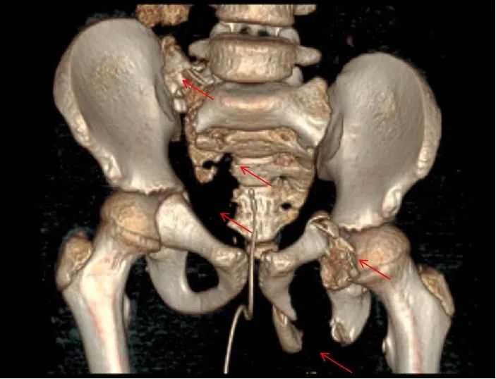 髋臼多发骨折,骶髂关节垂直移位,左侧髋臼骨折,左耻骨支骨折,左侧坐骨