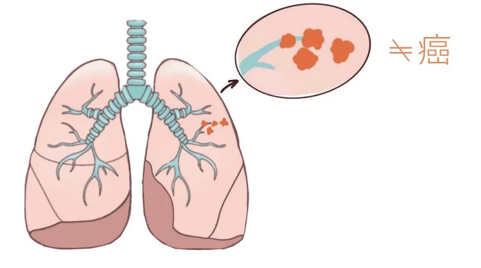 肺结节卡通图片图片