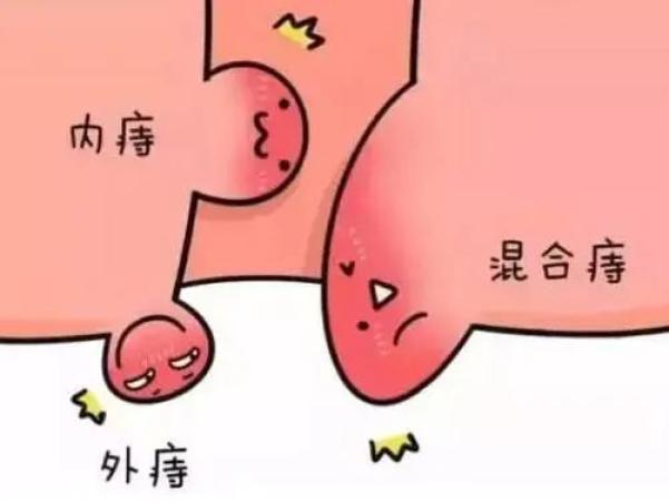 多发于肛门截石位3,7,11点处,以11点更多见.